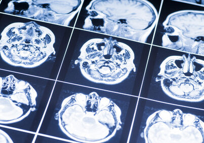 MRI of the brain. snapshot